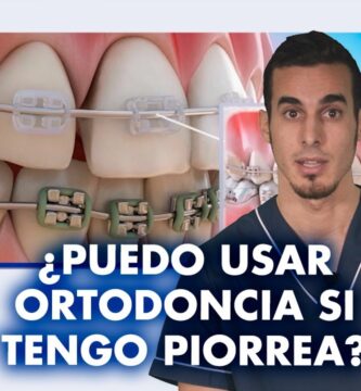 como puedes diferencial el cuarzo de una ortodoncia