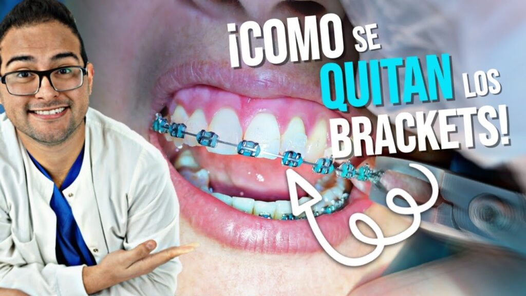 como quitar brackets de ortodoncia