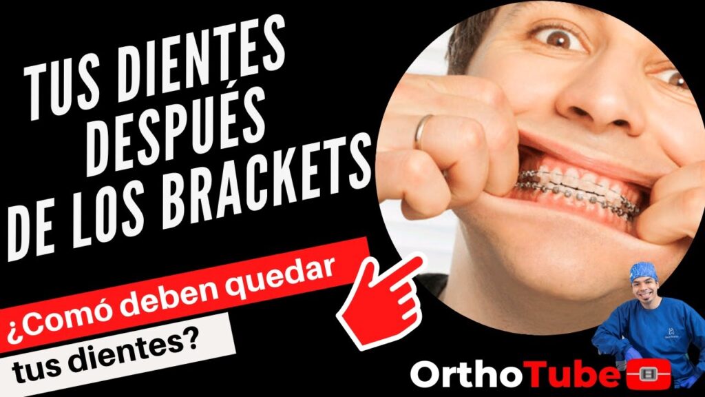 como se debe quedar una dentadura con ortodoncia