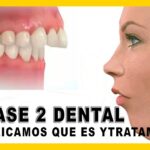 correccion clase ii ortodoncia hueso