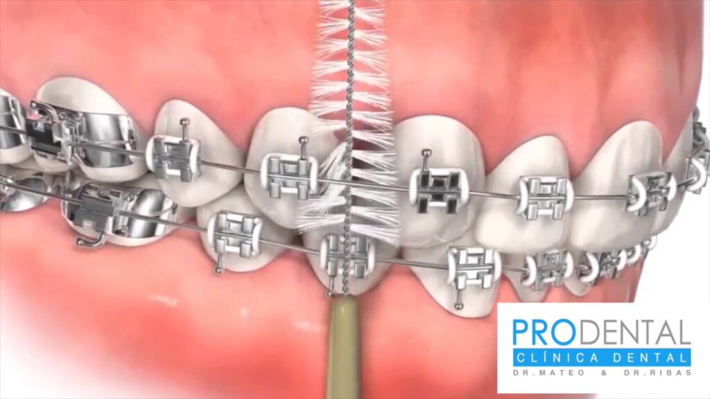 correcto cepillado con ortodoncia