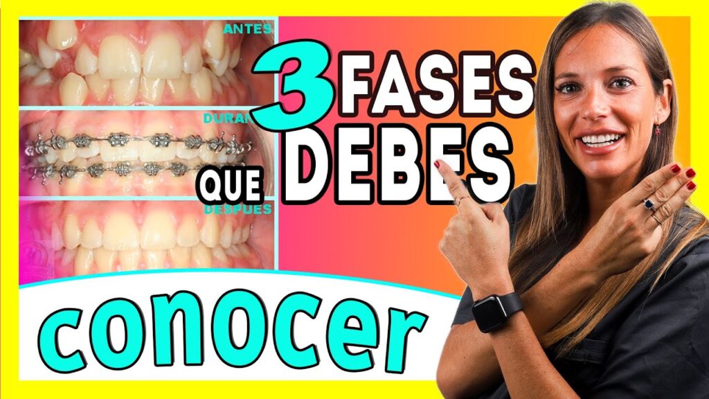 cuales son lis tratamientos de segundafase en ortodoncia