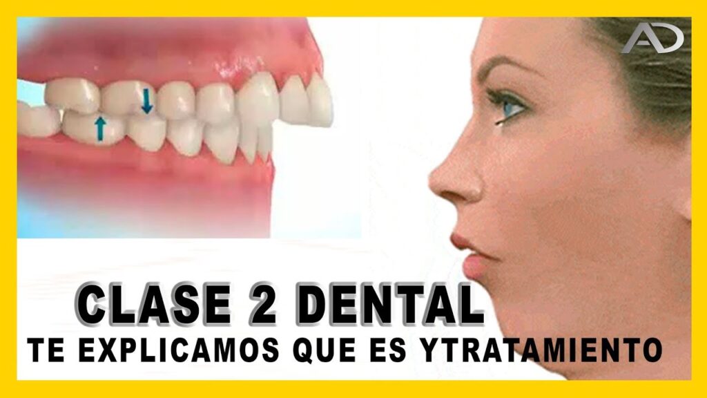 cuando corregir maloclusion dental clase 2 con ortodoncia adultos