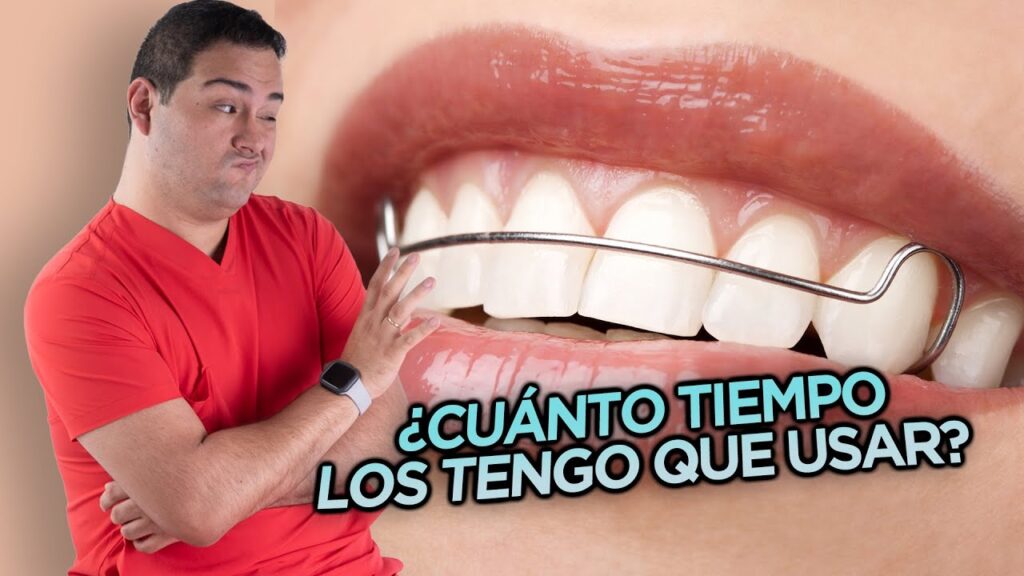 cuanto tardan los dientes a descolocarse despues de una ortodoncia