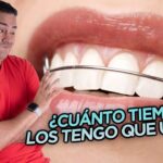 cuanto tardan los dientes a descolocarse despues de una ortodoncia