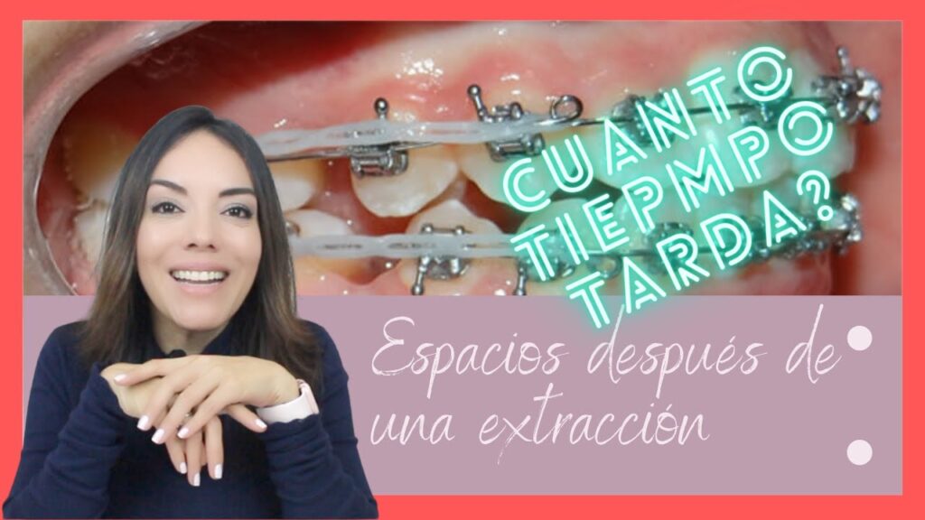 cuanto tiempo tarda en cerrar un diastema con ortodoncia