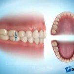 dentadura perfecta ortodoncia antes y despues