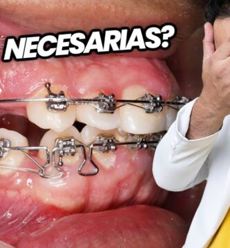 dentaduras con extracciones de premolares por ortodoncia