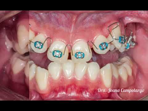 dental tratamien to de ortodoncia