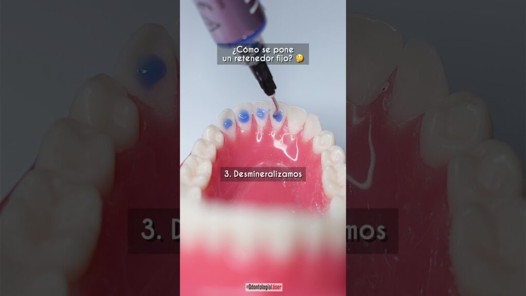 desprogramacion de los dientes despues de ortodoncia