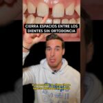 diastema ortodoncia cuanto dura