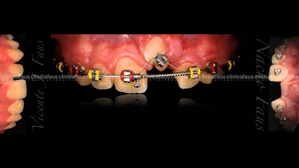 diente retenido ortodoncia