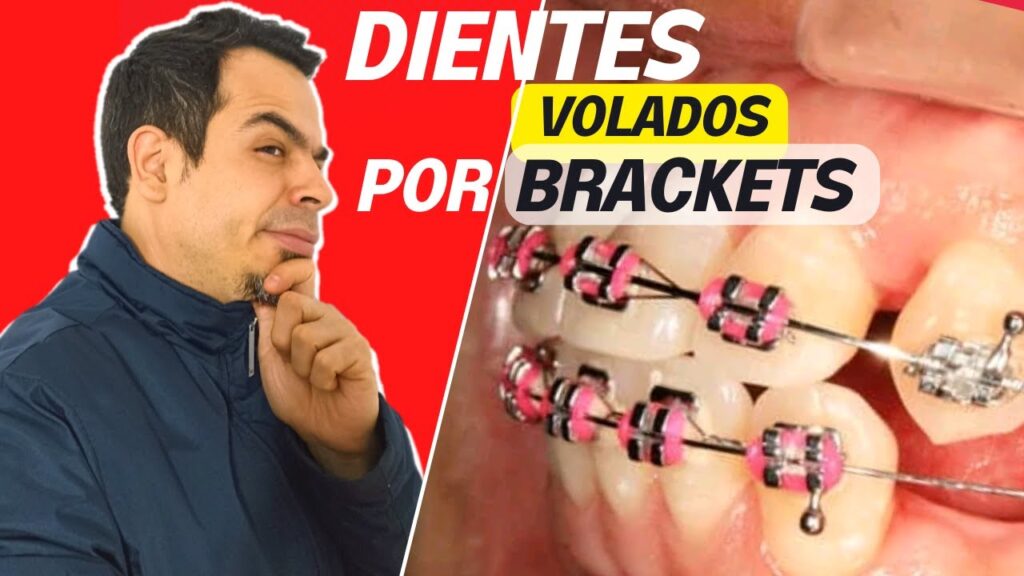 dientes hacia adelante ortodoncia