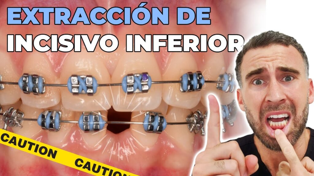 dientes incisivos inferiores ortodoncia