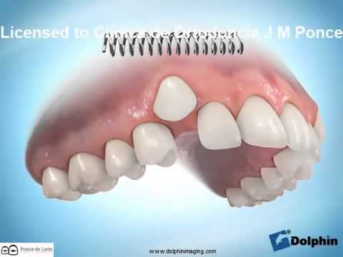 dientes montados paleta corregido con ortodoncia