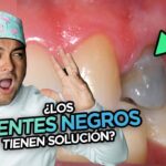 dientes oscuros por ortodoncia