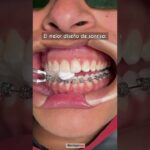 dientes perfectos despues de la ortodoncia