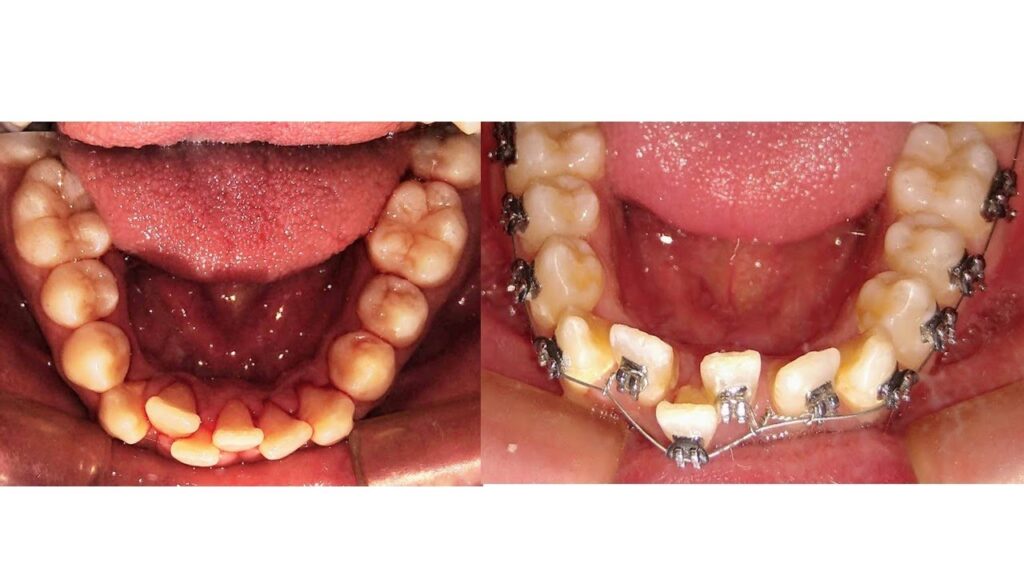 dientes torcidas se repara con ortodoncia