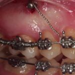 distalamiento molar en ortodoncia