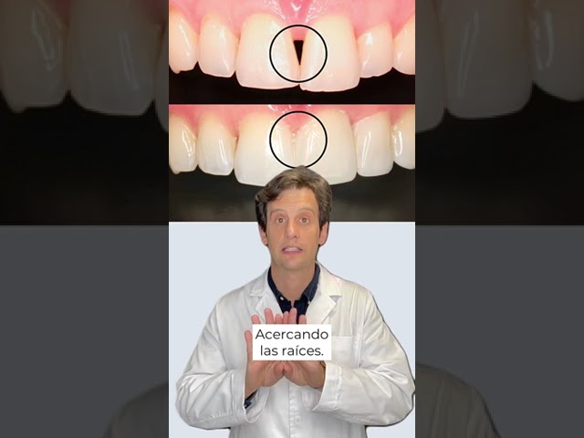 dolphin imagenes de recesiones gingivales en ortodoncia