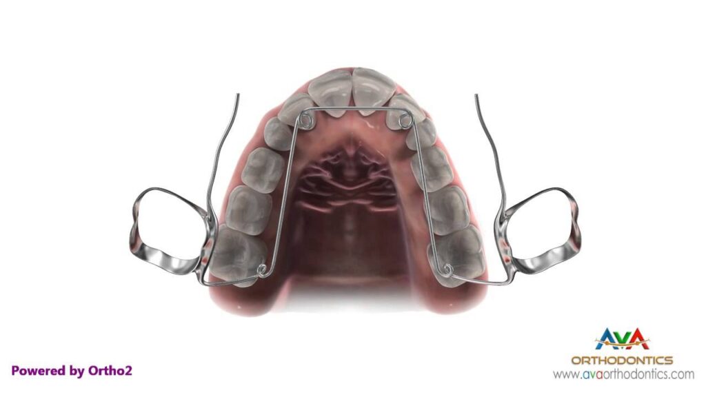 dual helix ortodoncia