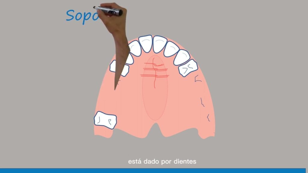 efecto de ortodoncia de los retenedores en protesis parcial removible