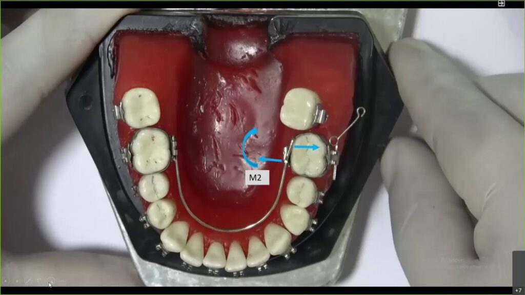 elásticos ortodoncia primer molar inferior y segundo molar superior