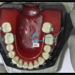 elásticos ortodoncia primer molar inferior y segundo molar superior