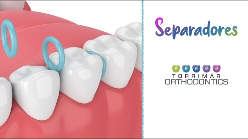 elastomeros para separar diente de ortodoncia