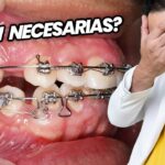 en ortodoncia es necesario sacar dientes