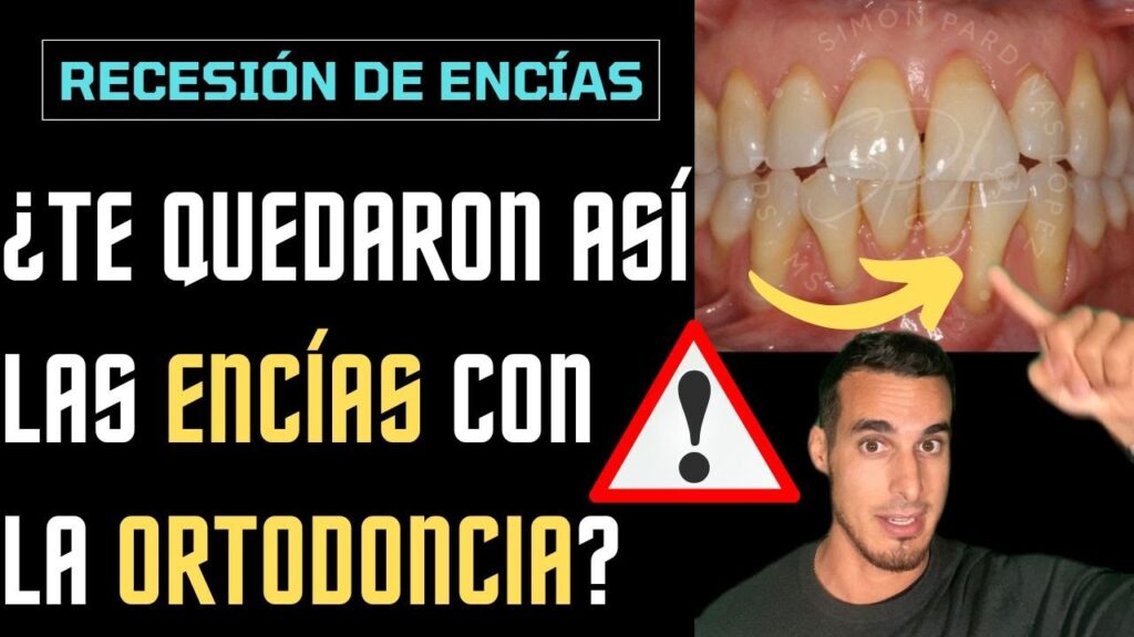 encia retraida ortodoncia