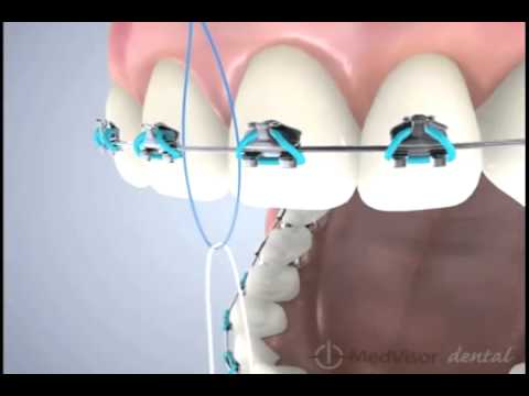 enhebradores ortodoncia