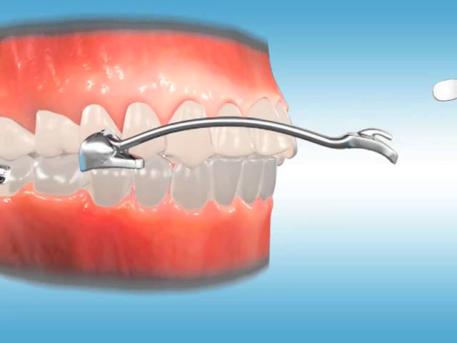 equiplano ortodoncia