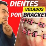 errores en ortodoncia dientes superiores inclinados lateralmente