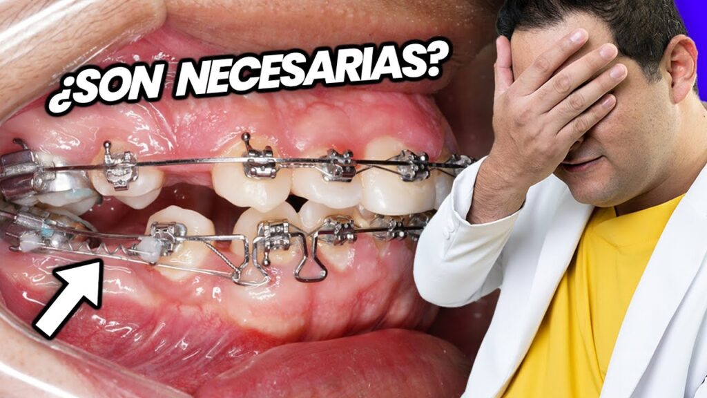 es necesario quitar premolares para ortodoncia