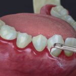 es necesario un tratamiento periodontal para la ortodoncia