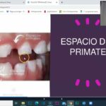 escalon mesial distal y recto ortodoncia