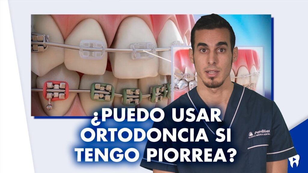 estudios de lesiones gingivales con la ortodonci