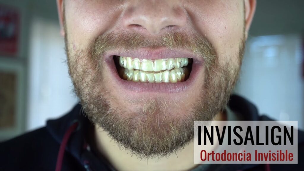 experiencia invisalign ortodoncia invisible