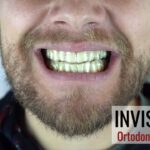 experiencia invisalign ortodoncia invisible