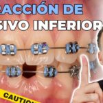 extraccion de un incisivo inferior en ortodoncia