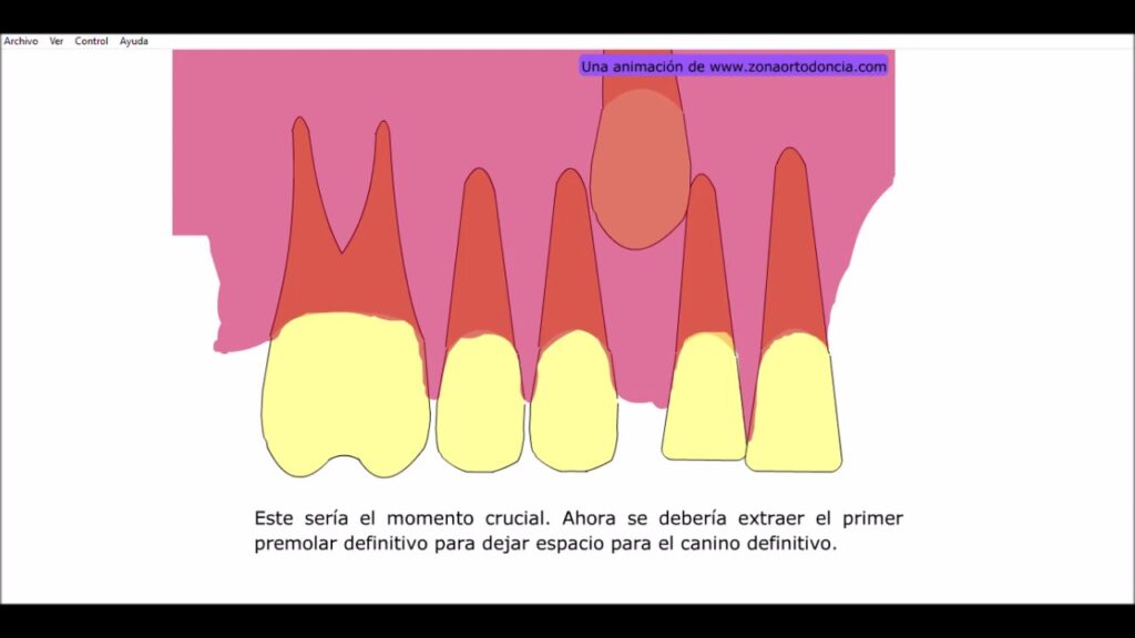 extraccion.seriada en ortodoncia