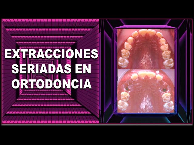 extracciones seriadas en ortodoncia