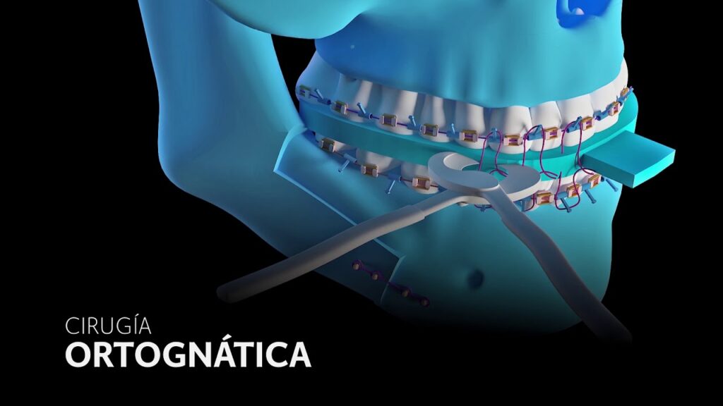 fases ortodoncia cirugia ortognatica