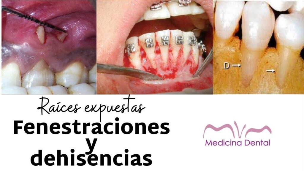 fenestracion por ortodoncia