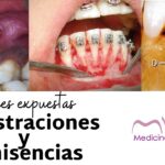 fenestracion por ortodoncia