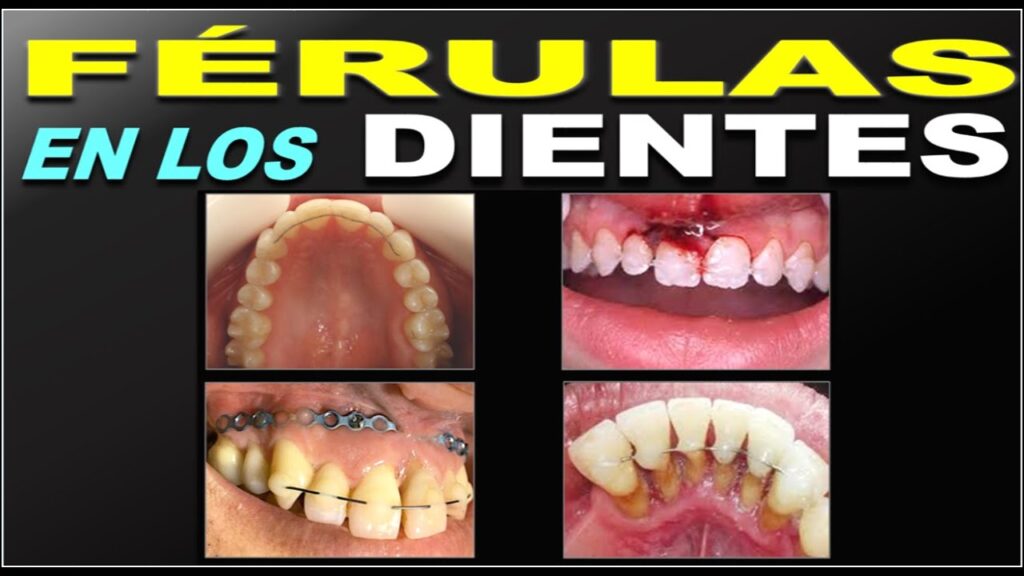 ferulizacion dental ortodoncia