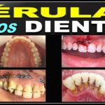 ferulizacion dental ortodoncia