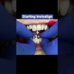 foro ortodoncia invisalign