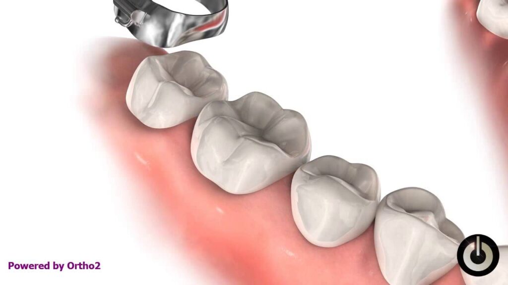 foto ligadura de separacion de molar en ortodoncia